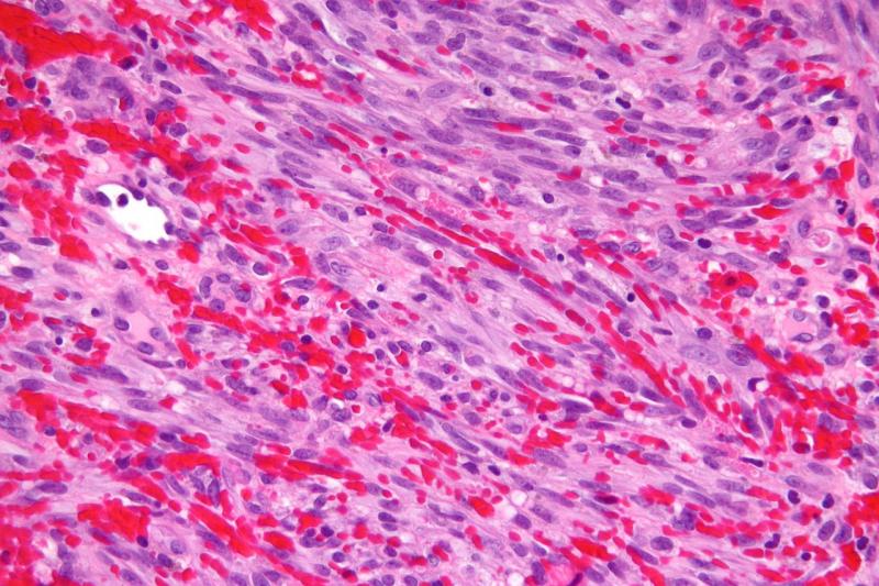 Micrograph of a Kaposi's sarcoma (Nephron / Wikimedia Commons)