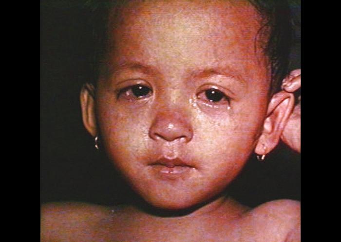 Child with measles (Barbara Rice / CDC)