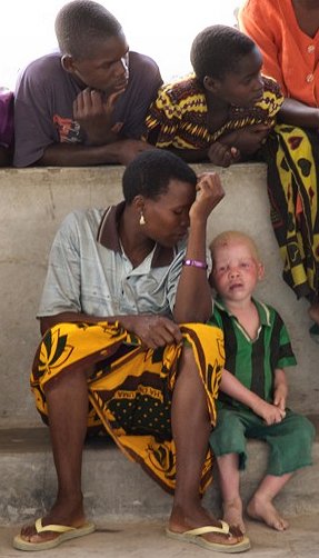 Albino children in Tanzania are targeted for their body parts (Wikimedia Commons)