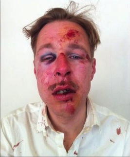 This picture of Wilfred De Bruijn after being assaulted near his Paris home have raised concerns over violence against homosexuals (Wilfred de Bruijn / Facebook)