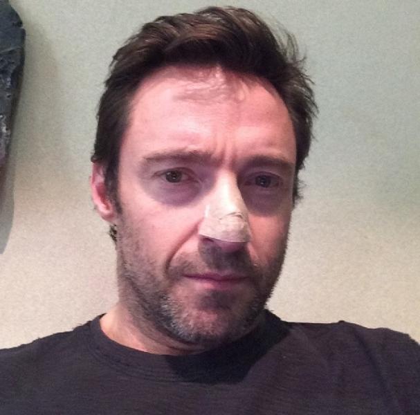 Hugh Jackman shows the aftermath of his skin cancer scare. (@thehughjackman on Instagram)