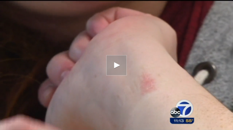 Evans says wearing the Fitbit Charge gives her a constant itch. (KGO)